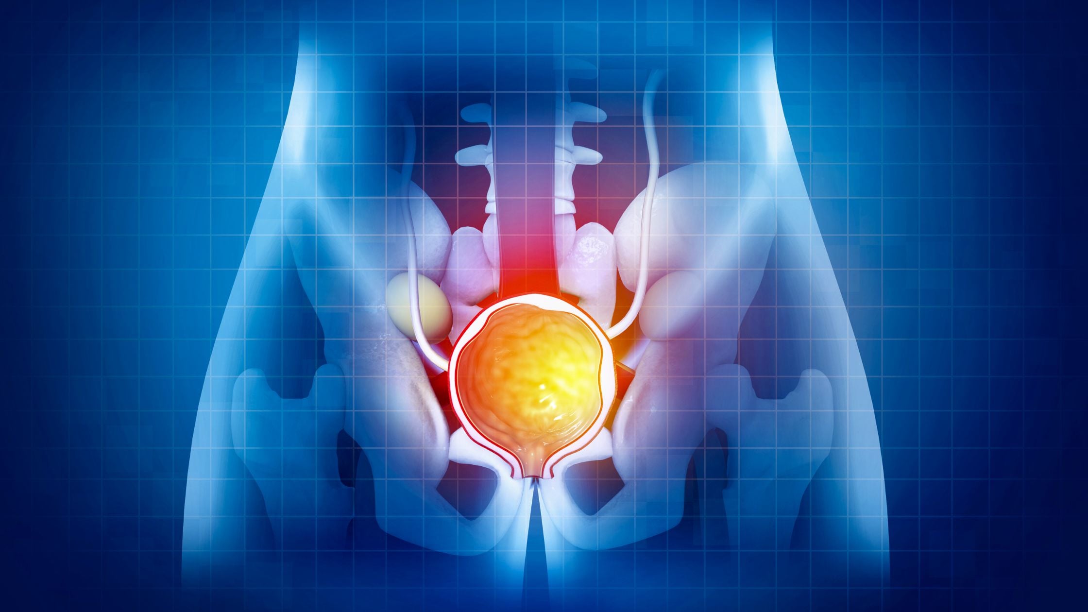 Benign Prostatic Hyperplasia (BPH): Symptom, Treatment & Management