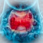 thyroid cancer