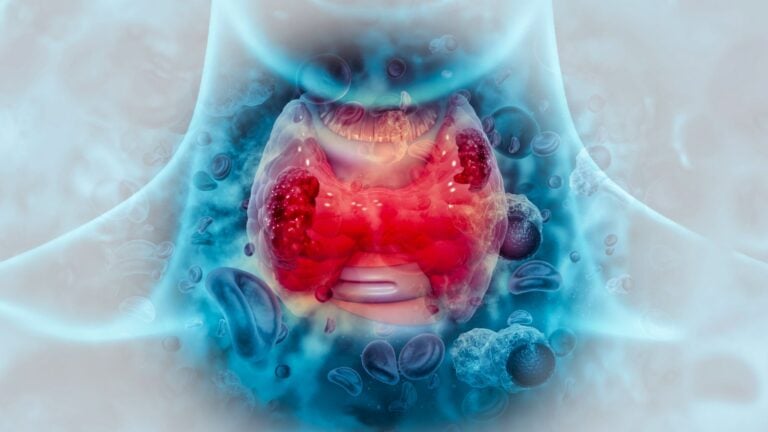 thyroid cancer